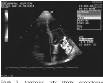 Figure  3. Transthoracic  color  Doppler  echocardiogram  demonstrating  severe  mitral  regurgitation  with  eccentric  jet  directed  toward  the  left  atrium.