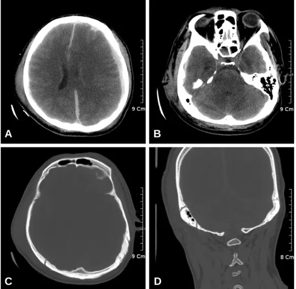 Fig. 1. Preoperative computed tomography (CT) scans. a, b: Preoperative CT scans show left dominant, bilateral subdural hematoma with midline shift to the right