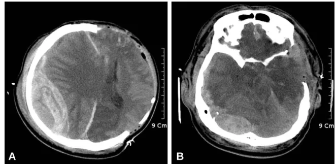 Fig. 2. Computed tomography (CT) scans just after decompressive surgery. a,  b: Immediate postoperative CT scans show a con- con-tralateral supra- and infratentorial epidural hematoma with significant mass effect, resulting in severe brain swelling.