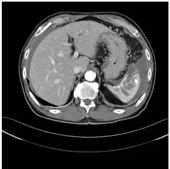 Fig. 1. Computed tomography revealing the extent of the splenic injury.