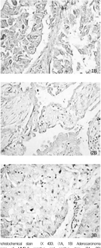 Figure  1.     Non  small  cell  lung  cancer  stained  with  immunohistochemical  stain    (X  400)