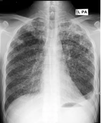 Figure  1.   Chest  PA  shows  multiple  nodules  in  whole  lung  field  and  consolidation  of  both  upper  lobes  with  left  pleural  effusion.