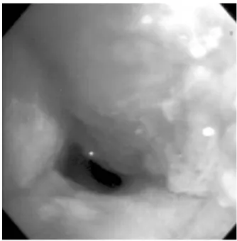 Figure  2.     A  CT  scan  demonstrates  an  obstructing  mass  and  total  collapse  of  left  upper  lobe