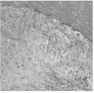 Figure  4-2. High  power  microscopy  showed  septated  fungal  organisms  with  acute  angulation,  suggesting  Aspergillus  species