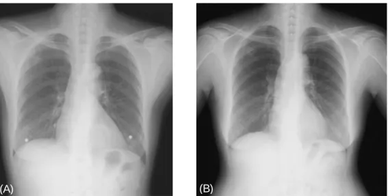 Figure  1.   Chest  PA  showed  a  round  nodule  in  right  upper  lobe  4  years  ago  (A)  and  reveals  no  interval  changes  in  solitary  pulmonary  nodule  on  admission  (B).
