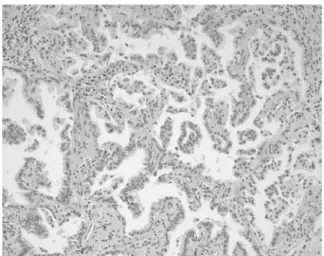 Figure  4. Microscopic  finding  shows  a  well-differenti