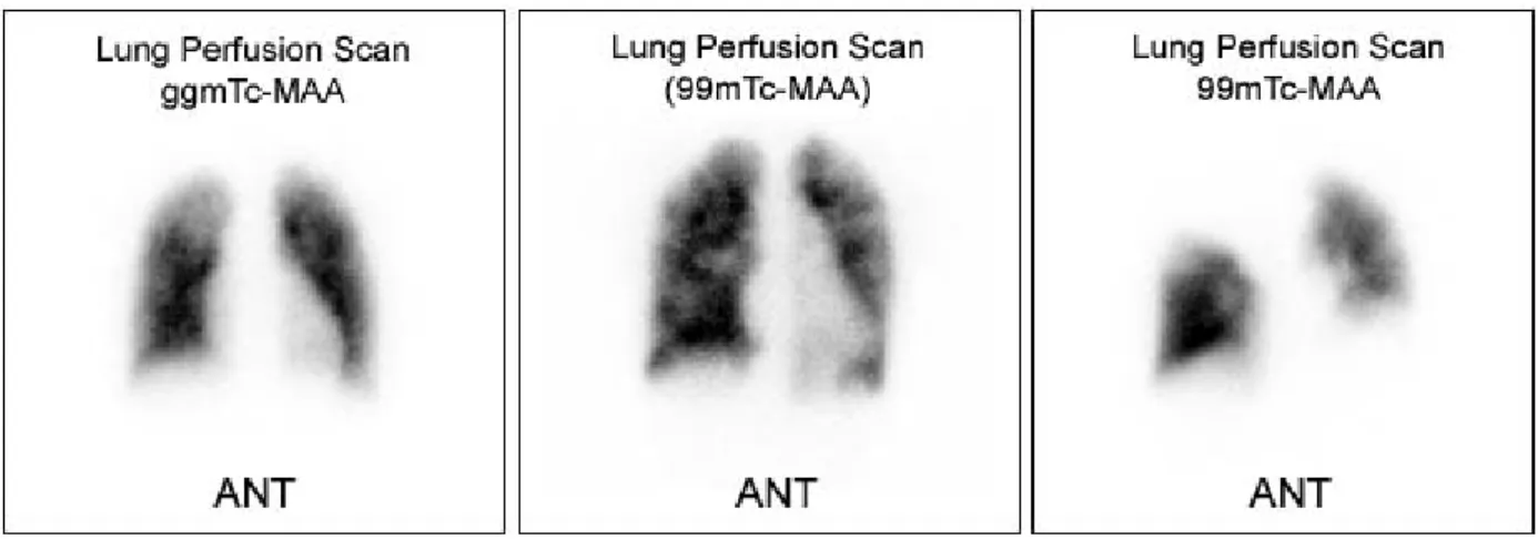 Figure  2.   Perfusion  lung  scan  findings;  normal  (left),  low  probability  (middle),  and  high  probability  (right)