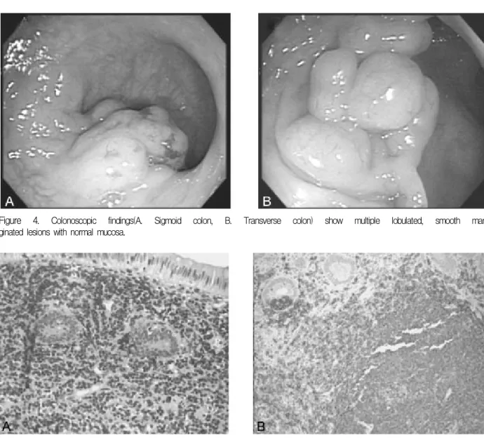 Figure  3. Histologic  findings  of  the  tracheal  specimens  (A.  Haematoxyline-eosin  staining,  B