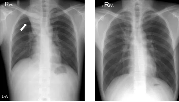 Figure  1.   On  admission,  Chest  PA  shows  linear  infiltration  in  right  upper  lobe