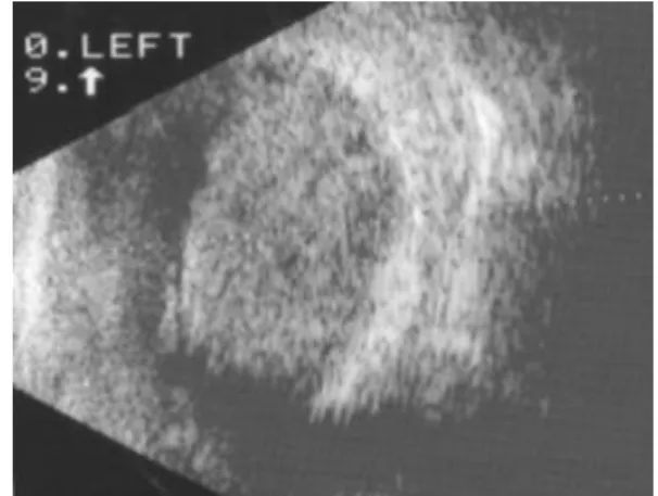 Figure  4.   B-scan  ultrasonogram  shows  an  oval  shaped  choroidal  mass  in  the  left  eye