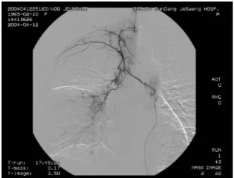 Figure  1.   Chest  PA(A)  and  right  lateral  view(B)  show  diffuse  consolidation  of  right  middle  lobe.