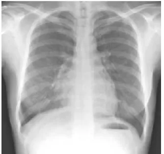 Figure  4. A.  Bronchoscopy  shows  black-colored  small  mass  covered  with  mucoid  material  on  orifice  of  right  middle  lobar  bronchus,  which  obstruct  right  lateral  segmental  bronchus