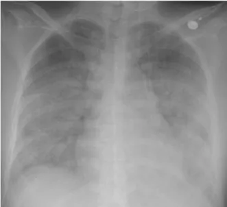 Figure  2.   Chest  CT  shows  diffuse  ground  glass  opacity  and  consolidation  with  interlobar  septal  thickening