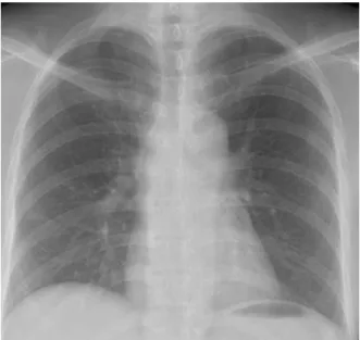 Figure  5.  Chest  PA    shows  normal  finding  on  both  lung  field  after  12  momth  from  discharge.