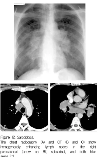 Figure  12.   Sarcoidosis. 