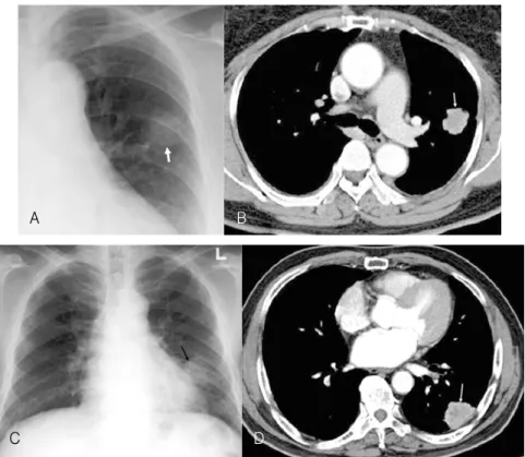 Figure  2.  Multiple  loculated  pleural  effusion.  A  chest  radiograph  shows  two  peripheral,  partly  well  defined  lesions  (arrows)  in  the  right  lower  lung  zone,  demons