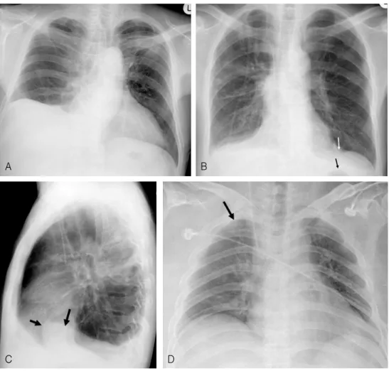 Figure  4.  Pleural  effusion.