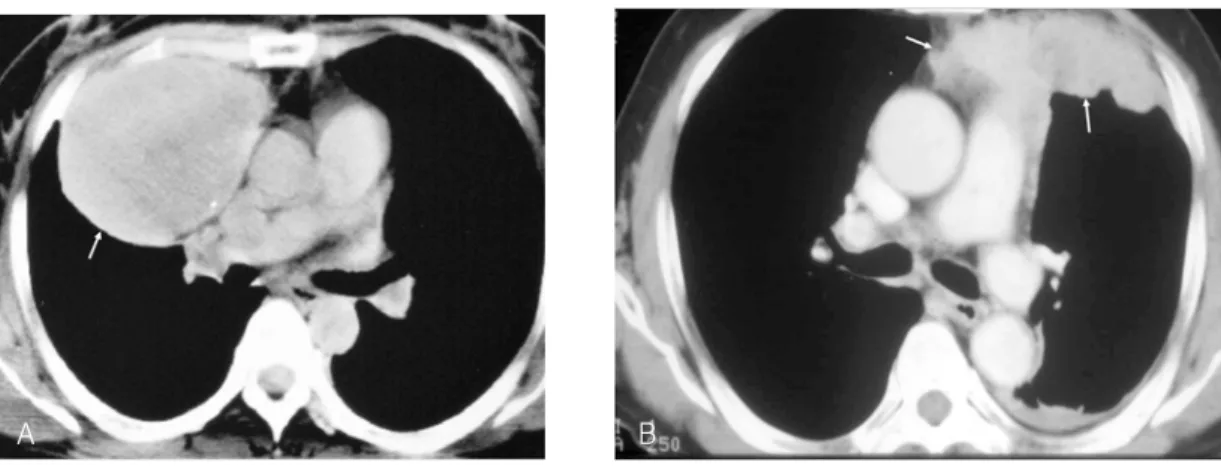 Figure  7.  Encapsulated  and  invasive  thymoma.