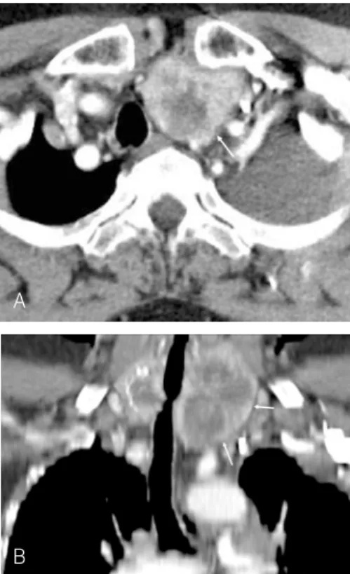 Figure  9.   Intrathoracic  goiter. 