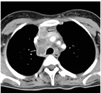 Figure  11.   Tuberculous  lymphadenopathy.