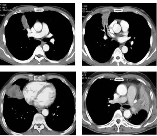 Figure  3.   Variable  causes  of  a  similar  pattern  of  a  mass  like  lesion  with  distal  obstructive  pneumonitis