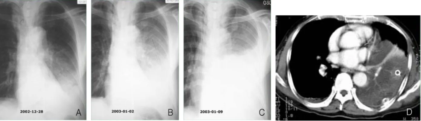 Figure  10.   Large  cell  carcinoma  in  59-year-old  man. 