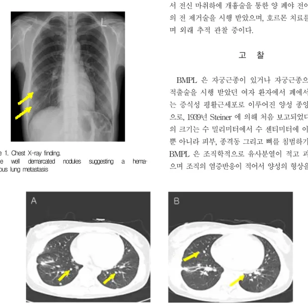 Figure  2.   Computed  tomography  findings  of  the  chest.