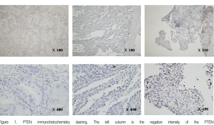 Figure  1.  PTEN  immunohistochemistry  staining.  The  left  column  is  the  negative  intensity  of  the  PTEN  immunostaining  in  the  malignant  epithelium