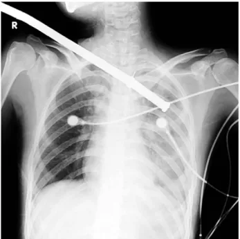Fig. 1. On preoperative chest X-ray, a large metallic bar was penetrating through the right cervical area to left upper lung field.