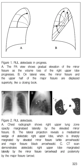 Figure  2.   RUL  atelectasis.