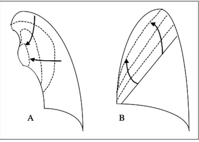 Figure  3.   LUL  atelectasis  in  progress.