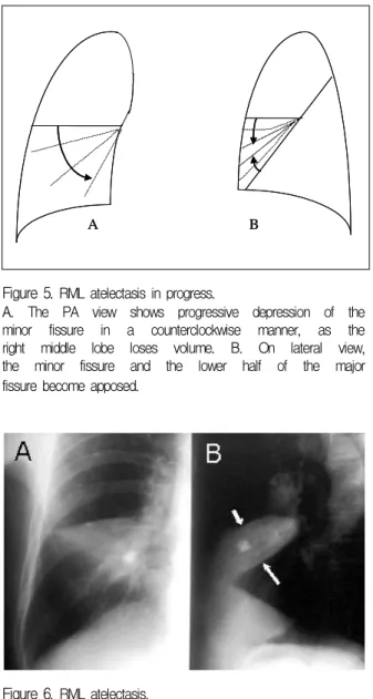 Figure  6.  RML  atelectasis.