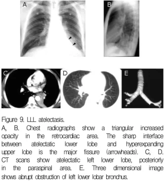 Figure  9.   LLL  atelectasis.