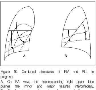 Figure  11.   Combined  atelectasis  of  RM  and  RLL  due  to  mucus  impaction  in  the  bronchus  intermedius.