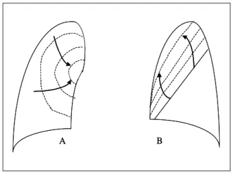 Figure  12.   Combined  RU  and  RML  atelectasis  in  pro