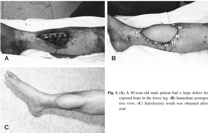Fig. 1. (A) A 40-year-old male patient had a large defect from exposed bone in the lower leg