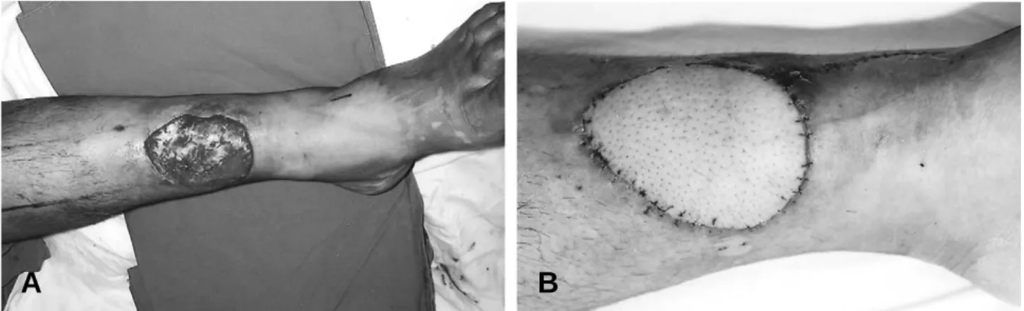 Fig. 2. (A) A 16-year-old male patient had a large defect after cellulitis in the lower leg