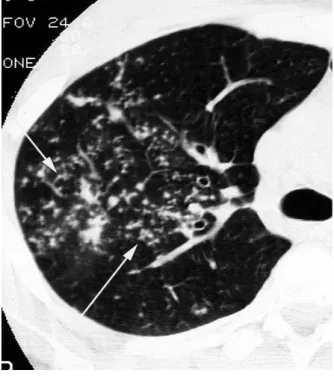 Figure  2.  Perilymphatic  distribution  of  nodules  in  a  patient  with  sarcoidosis.