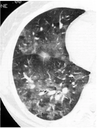 Figure  5.   Honeycombing  in  a  patient  with  IPF.