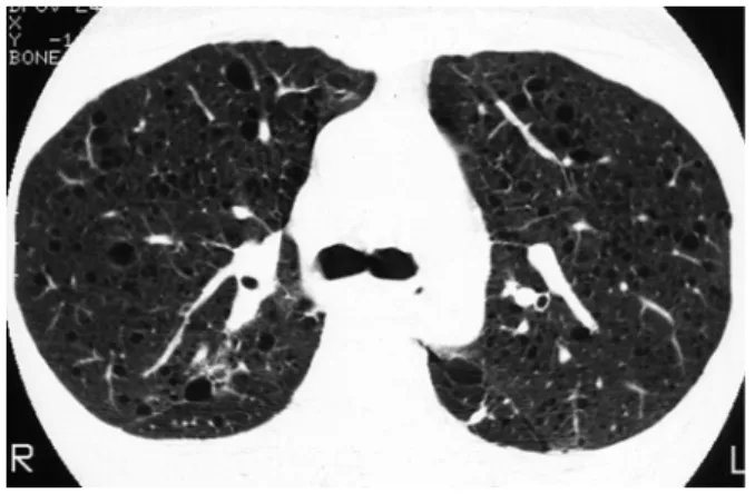 Figure  12.  Mosaic  perfusion  in  a  patient  with  post-  infectious  bronchiolitis  obliterans.