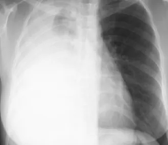 Figure  2.  3.  Initial  chest  CT  scan  demonstrates  about  2cm  sized  nodule  in  right  upper  lobe  with  ipsilateral  massive  pleural  effusion.