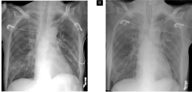 Figure  3.  A. Marked  interval  improvement  of  interstitial  markings  and  pulmonary  infiltration  is  seen  with  3  day  later  with  steroid  therapy