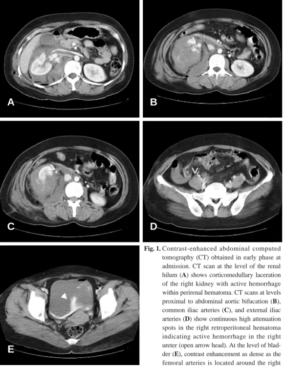 Fig. 1. Contrast-enhanced abdominal computed tomography (CT) obtained in early phase at admission