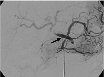 Fig. 5. Follow up CT angiography at fourth hospital day Successful restoration of hepatic arterial blood flow was identified with a patent stent.