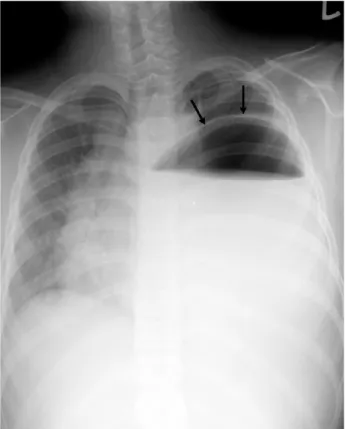 Fig. 2. Follow up chest X-ray after nasogastric tube insertion (arrow). Immediate improvement of chest compression is seen