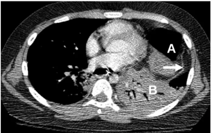 Fig. 3. Chest CT of tension viscerothorax. The air-trapped stomach (A) and ruptured diaphragm (arrow) in the left hemithorax are seen