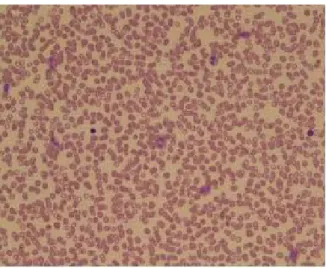 Figure  2 .  Bone  marrow  biopsy  specimen  shows  normocellular  marrow  with  marked  increase  of  eosinophils(23.2%)  (H&amp;E  stain  ×400).