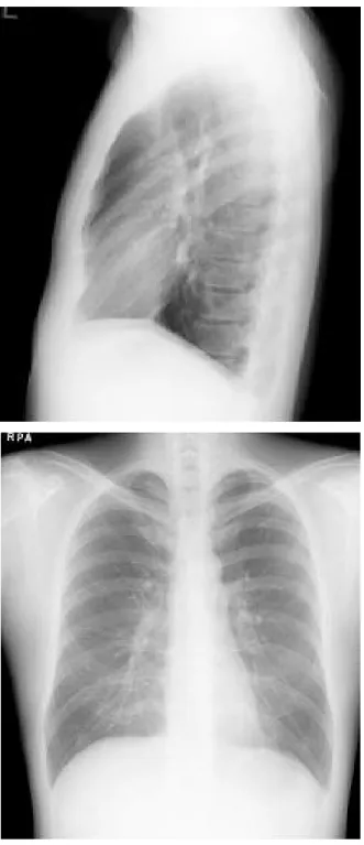 Figure  5. The  computed  tomography  of  chest  shows  pulmonary  thromboembolisms  of  both  segmental  pulmonary  artery.
