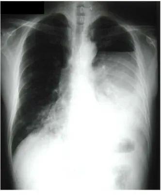 Figure 1. Plain  chest  radiograph  shows  a  large  cavity  in  left  hemithorax  containing  air-fluid  level