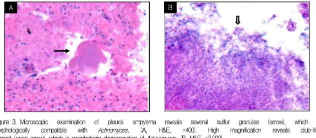 Figure 3. Microscopic  examination  of  pleural  empyema  reveals  several  sulfur  granules  (arrow),  which  is  morphologically  compatible  with  Actinomyces